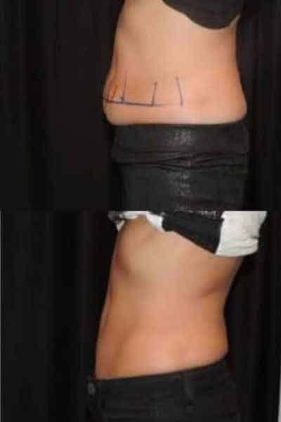 HIEMT Muscle Toning Ayr
