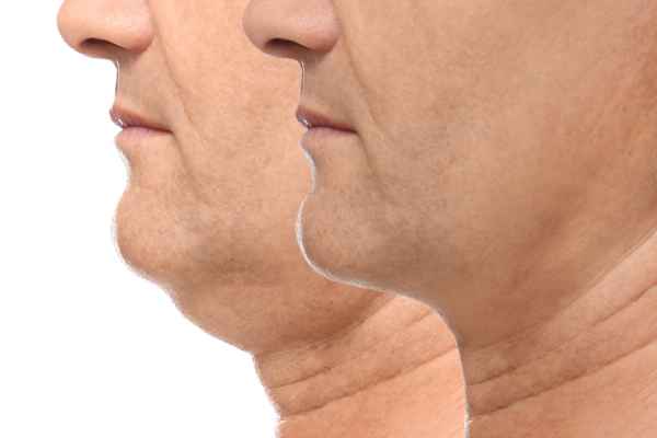 HIFU - Breakthrough in Anti - ageing 2 hifu results Ayr