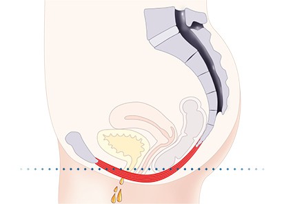 Pelvic-Floor Muscle Repair 5 Pelvic floor muscles Ayr