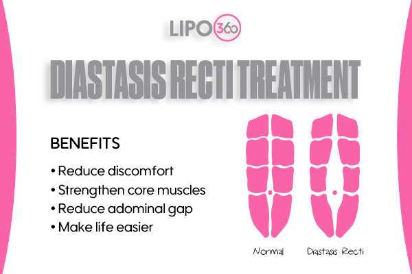 Revolutionising Muscle Repair: The Power of LIPO360 Body Sculpt Post-Injury 5 diastasis recti treatment Ayr