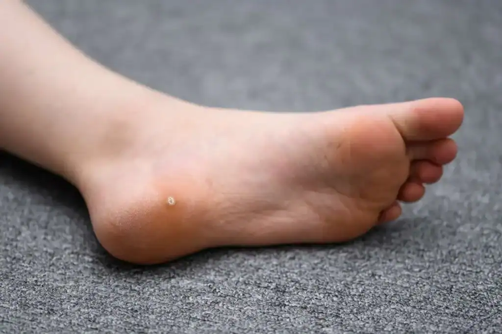 Cryotherapy For Warts And Also Verrucas 2 Image of verruca on the bottom of the foot that able to be treated with Cryotherapy Ayr
