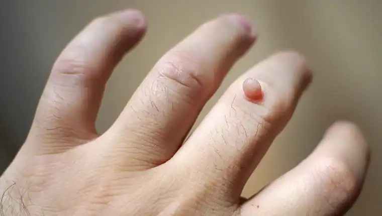 Image of blemish that Cryotherapy Ayr can remove with Lipo 360.