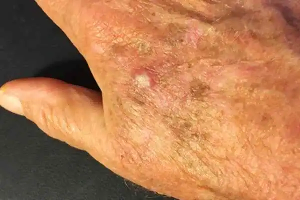 Image of Actinic keratoses Ayr on a person hand