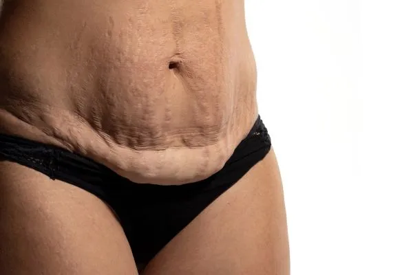 The Science of Skin Tightening 1 The science behind skin tightening Ayr picture of a woman's sagging skin on the stomach
